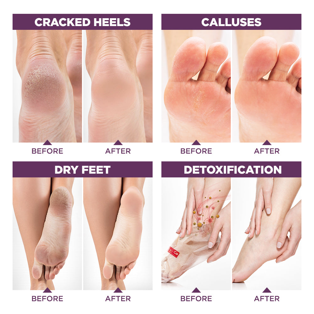 Dry Feet My Feet Are Peeling And Cracking My Heels Are Dry And