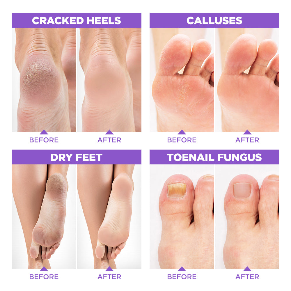 Lavinso Lavender Oil Foot Soak for Dry Cracked Foot with Epsom Salt