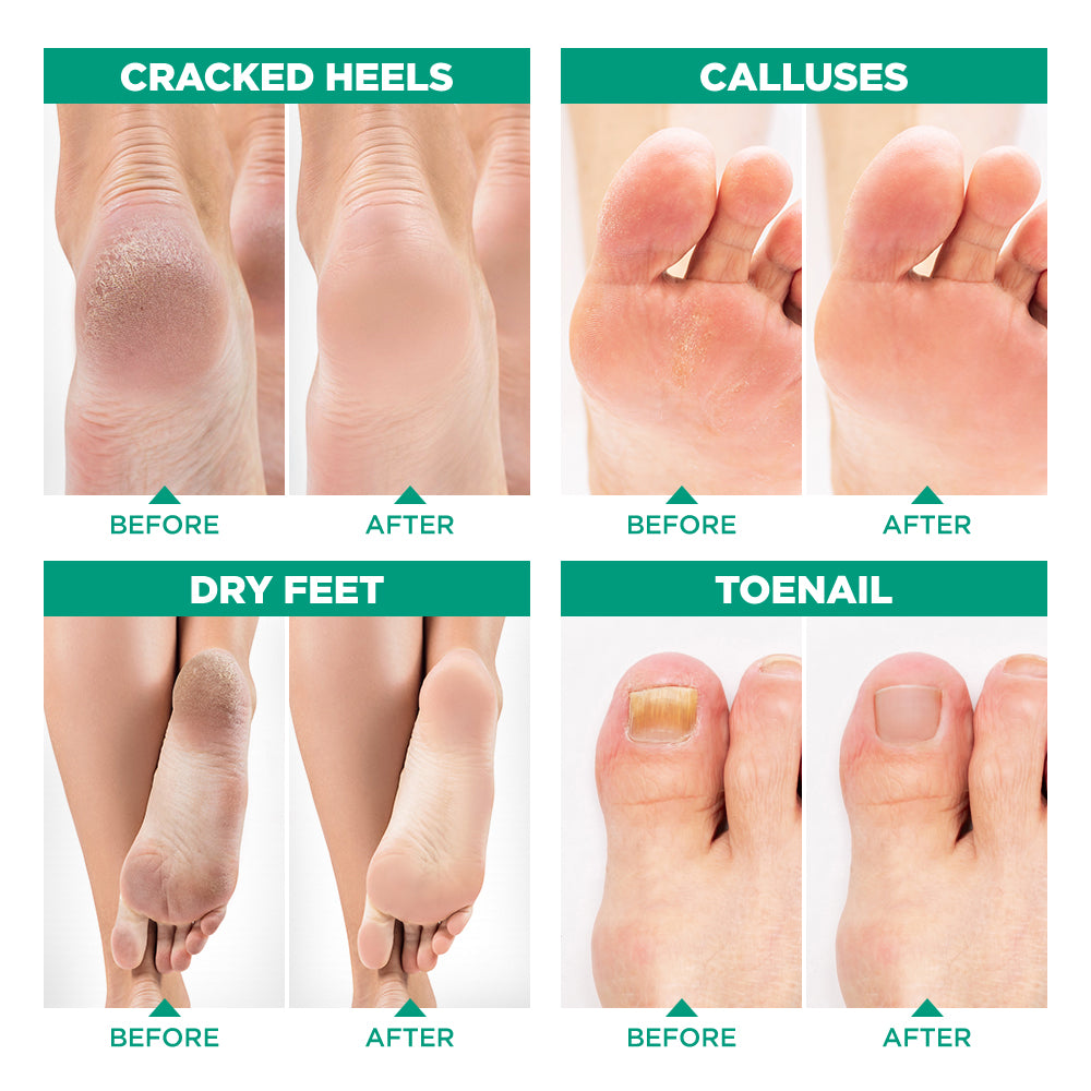 Lavinso Tea Tree Oil Foot Soak with Epsom Salt for Toenail Fungus and Athletes Foot