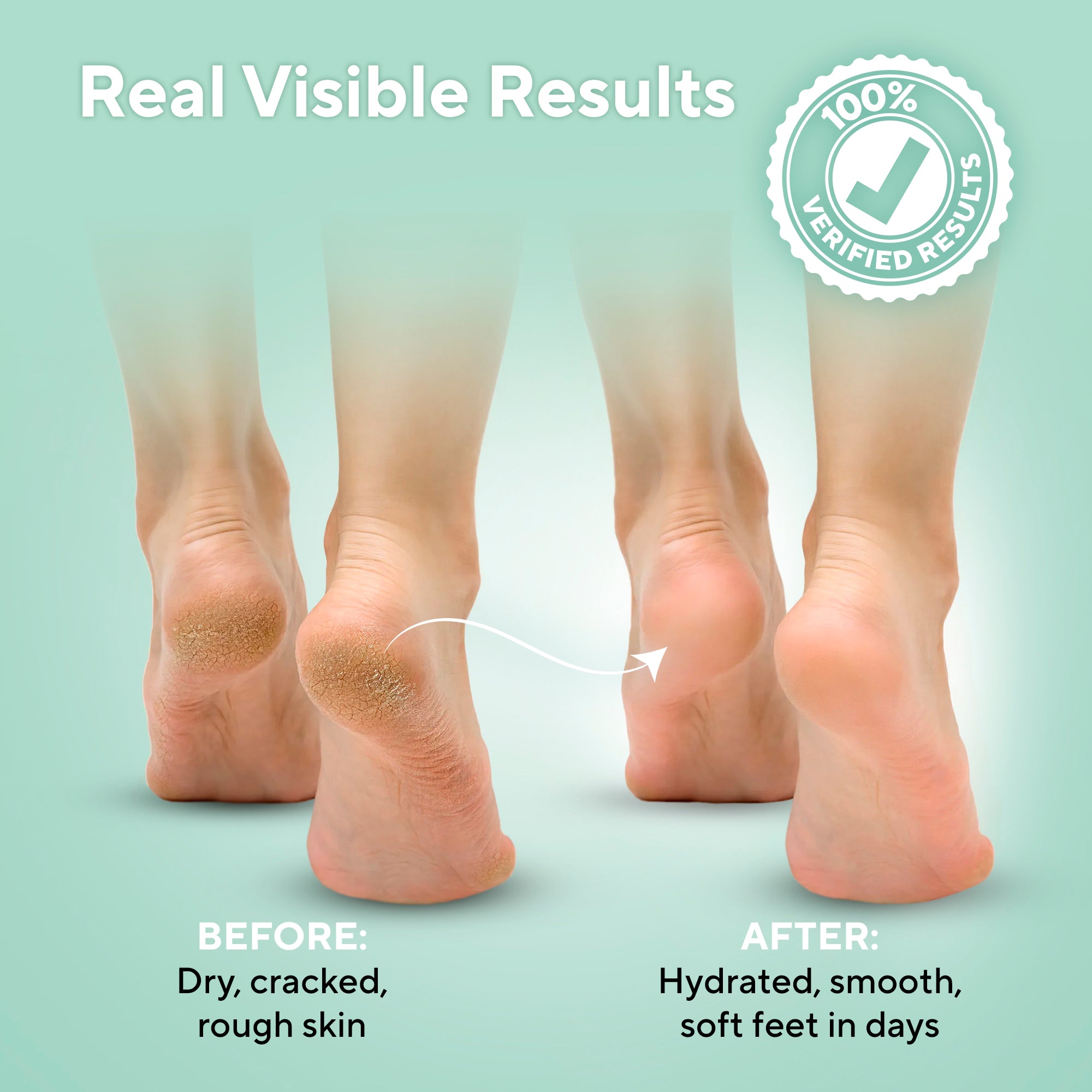 Lavinso Urea and Salicylic Acid Foot Cream